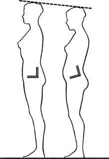 Example of anterior pelvic tilt (right) compared to normal pelvic positioning